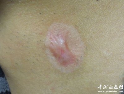 淺析放射性同位素敷貼治療方法_儀器修復(fù)_疤痕修復(fù)_中國(guó)疤痕網(wǎng) - 您身邊的疤痕修復(fù)專(zhuān)家